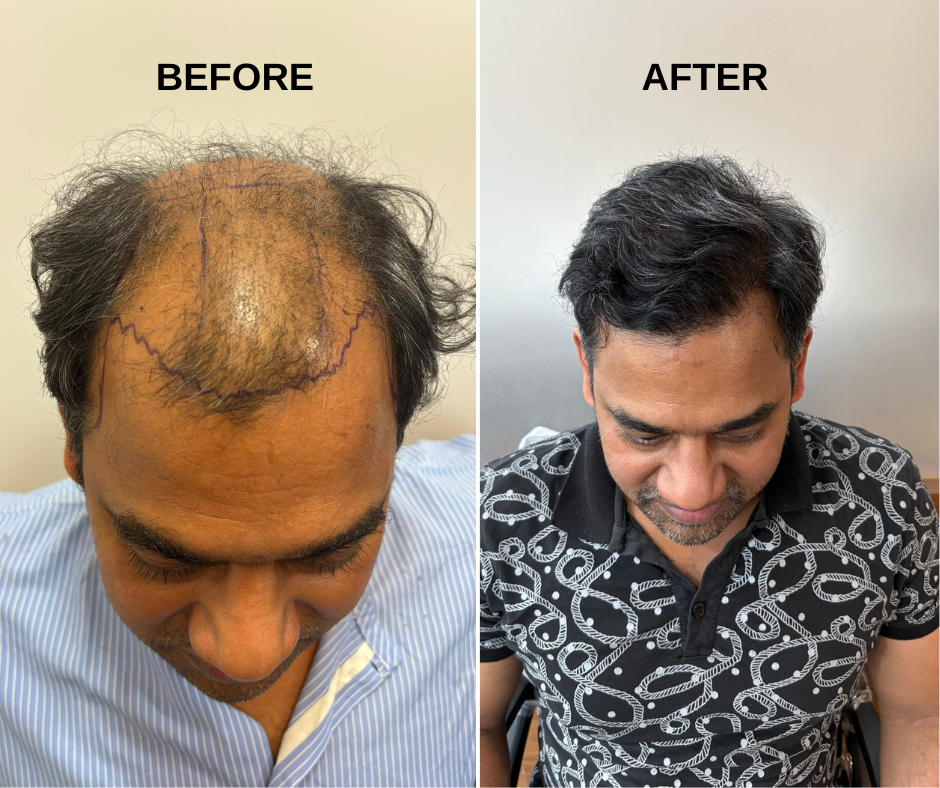 Hair Transplant Result at HairSense - Natural hairline, permanent results